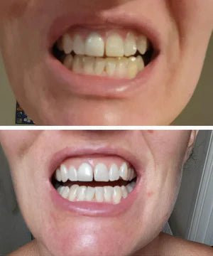 Feimuko Purple Teeth Whitening Strips