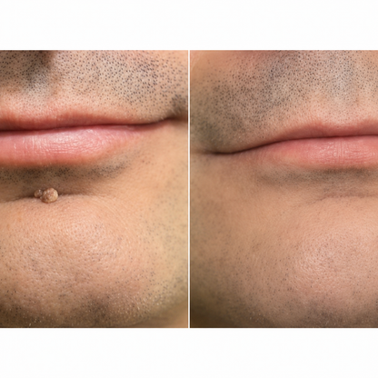 🌟 2-in-1 Microneedle & Hydrocolloid Patch 🌿 Invisible Face & Body Patches for Raised Moles, Acne, Flat Warts & Skin Tags - Helps Improve the Appearance of Wrinkles, Scars & Blemishes
