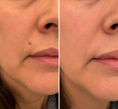 🌟 2-in-1 Microneedle & Hydrocolloid Patch 🌿 Invisible Face & Body Patches for Raised Moles, Acne, Flat Warts & Skin Tags - Helps Improve the Appearance of Wrinkles, Scars & Blemishes